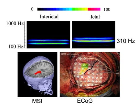 Spectrograms, magnetic source imaging (MSI) and intracranial recordings from a patient show the frequency and spatial features of interictal and ictal high-frequency brain signals (HFBS).